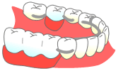 歯が数本抜けた場合の治療