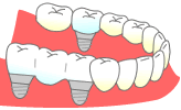 歯が数本抜けた場合のインプラント治療