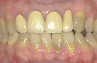 メタルボンドとセラミックス