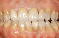 メタルボンドとセラミックス